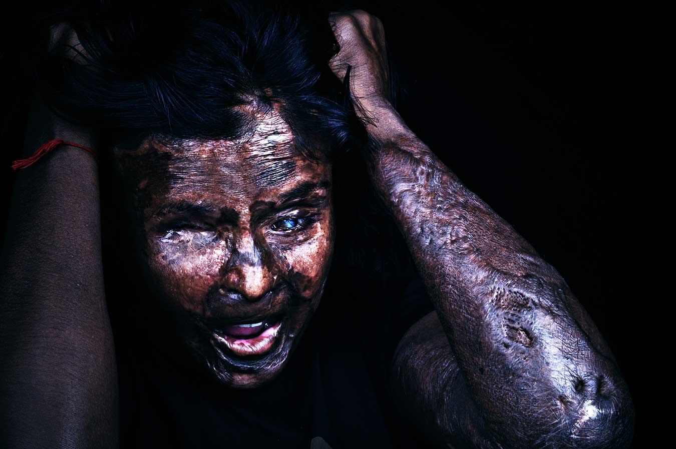 11-acid-attack-photo-story-journalism-india