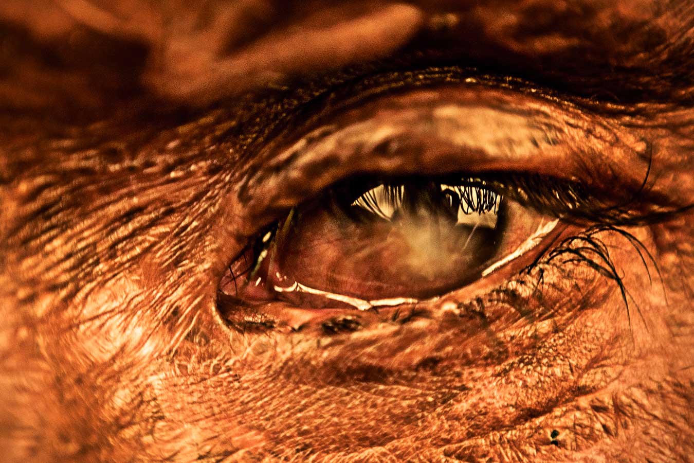 11a-acid-attack-victim-blank-eyes-skin-burnt