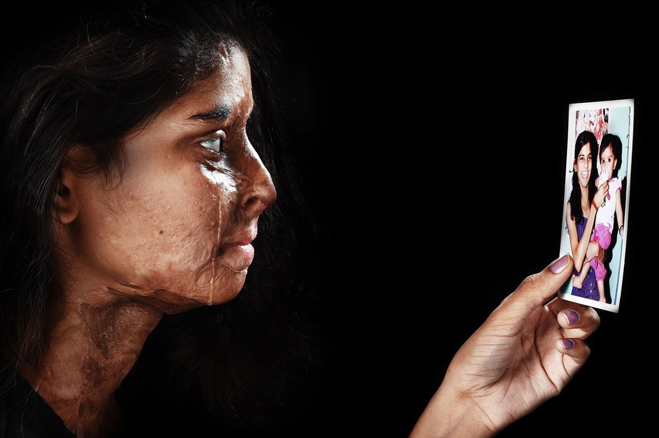 14_nostologia_ritu_acid_attack_victim_sad