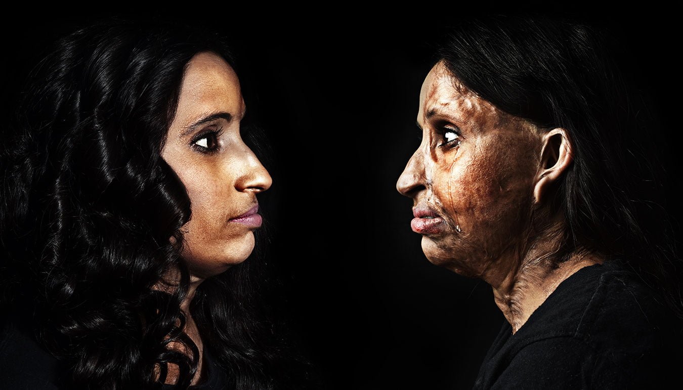 15-better-half-acid-attack-best-photographer-world