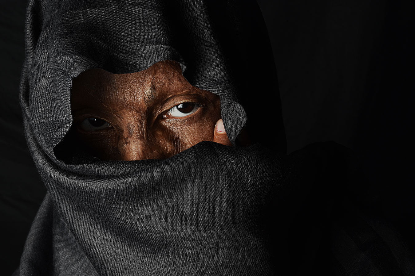 17-acid_attack-top-delhi-indian-photographer