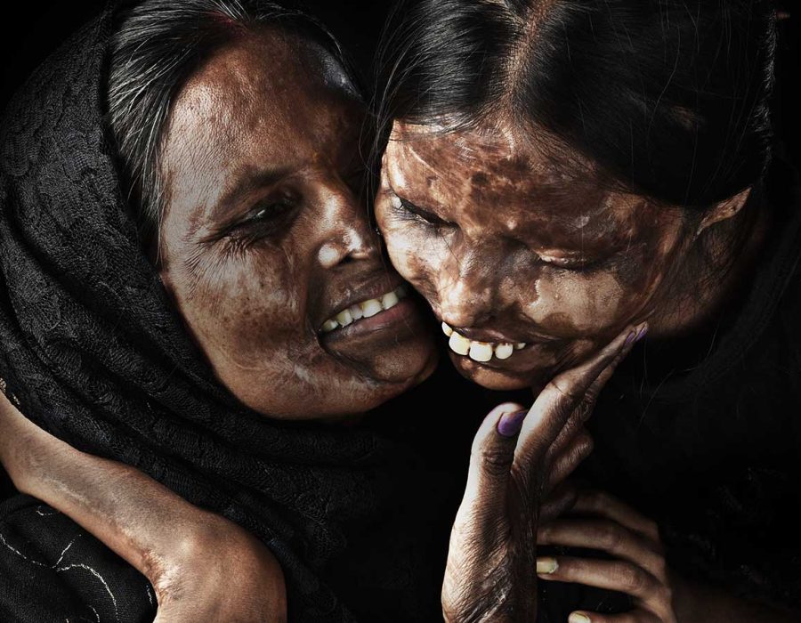 24-award-winning-photograph-acid-attack