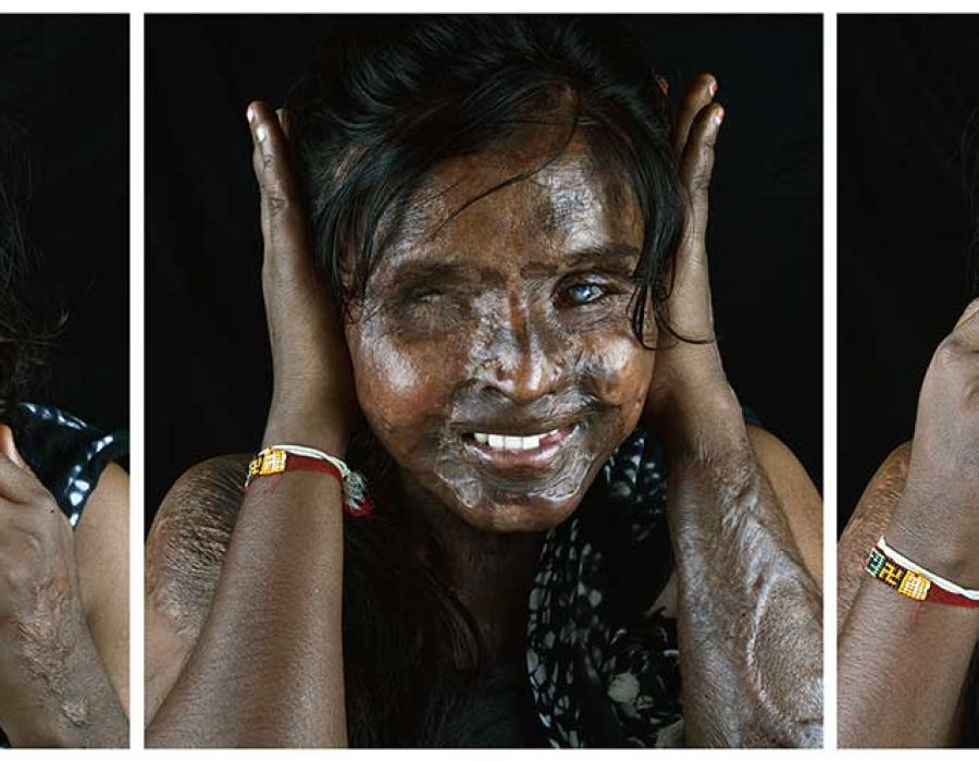 26_Gandhi-jis-monkey-happy-acid-attack-survivor